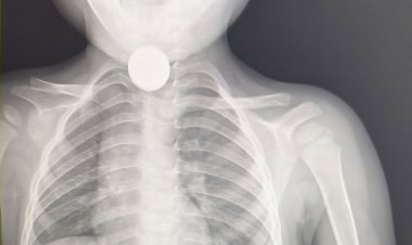 3 साल के बच्चे ने खेलते खेलते निगल लिया 5 का सिक्का