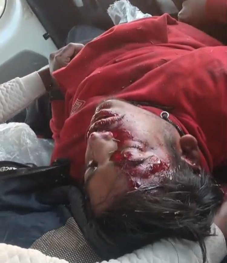 डिवाइडर से टकराई बाइक युवक गम्भीर घायल इंदौर रेफर